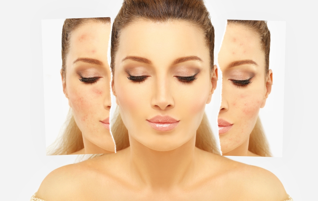 Acne Treatment